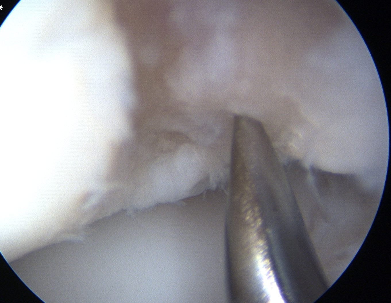 Elbow scope OCD Microfracture